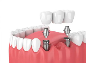 Educational video for Dental Prostheses at Foothill Dental Care in Livermore