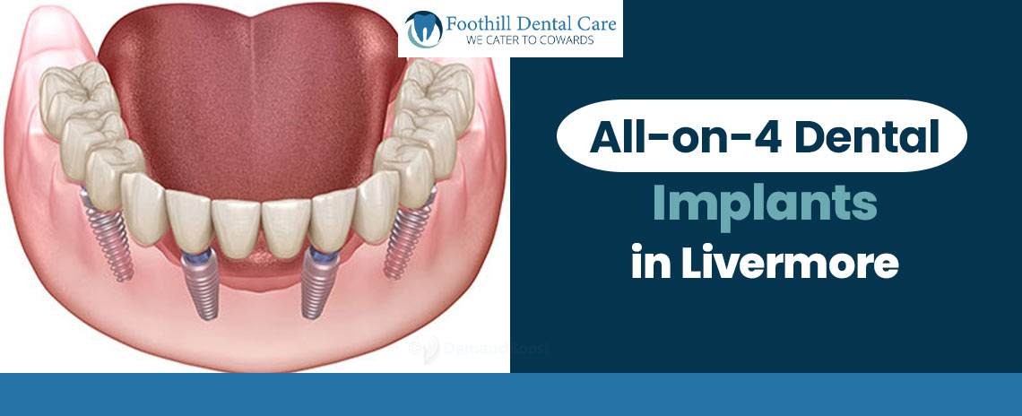All-on-4 Dental Implants in Livermore at Foothill Dental Care