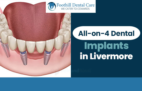 All-on-4 Dental Implants in Livermore