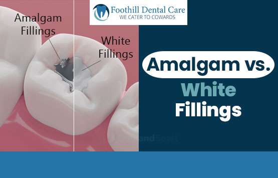 amalgam-vs-white-fillings-Livermore