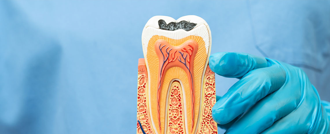 Cavity Prevention in Livermore