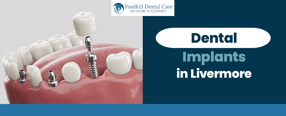 Dental Implants in Livermore at Foothill Dental Care in Livermore