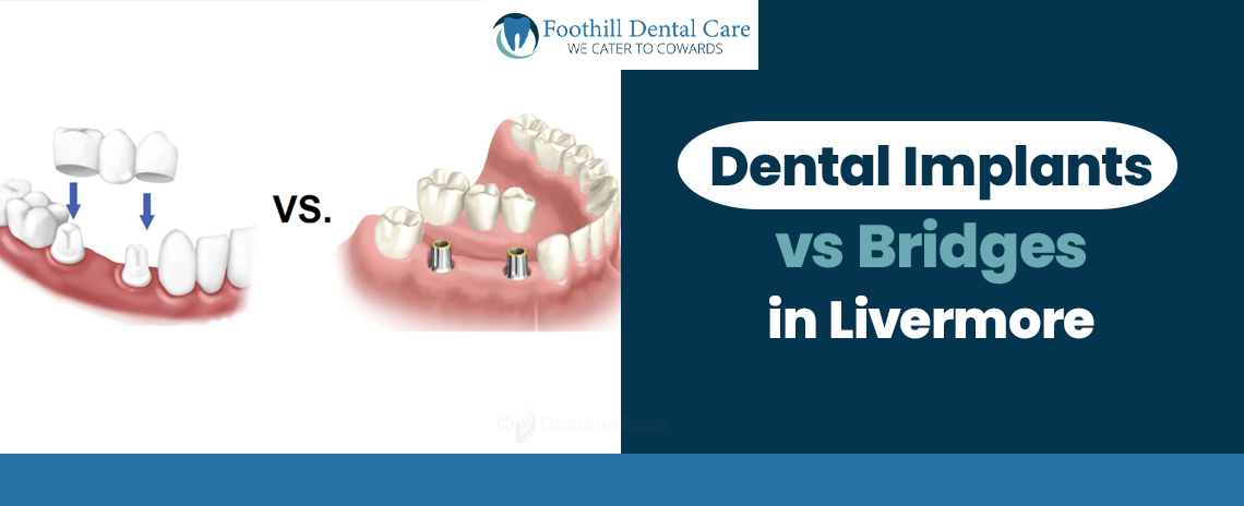Dental Implants vs Bridges in Livermore at Foothill Dental Care