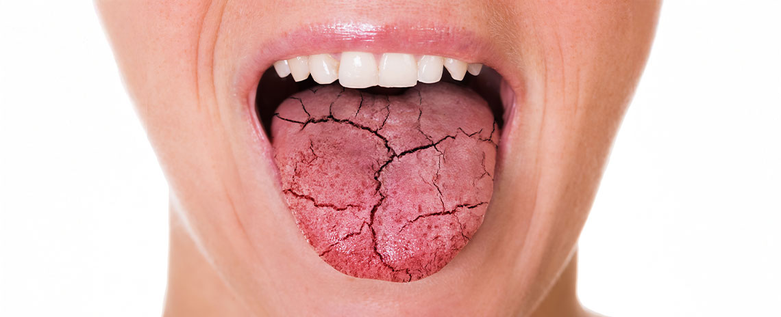 Dry Mouth Treatment at Foothill Dental Care in Livermore