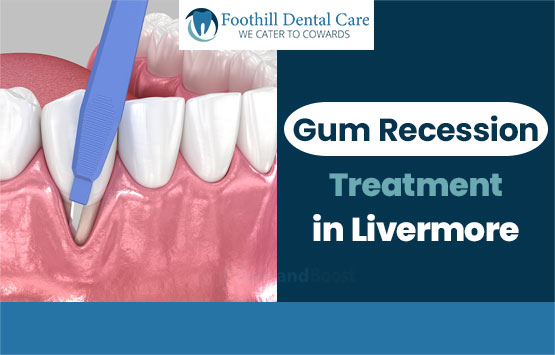 Gum Recession Treatment in Livermore