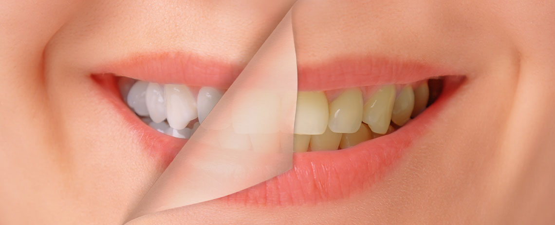 Harmful Dental Trends at Foothill Dental Care in Livermore