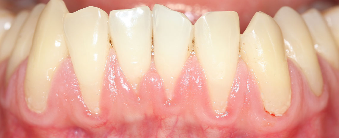 National Gum Disease Awareness Month at Foothill Dental Care in Livermore