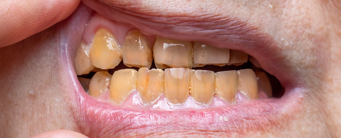 Tobacco Dangerous To Oral Health