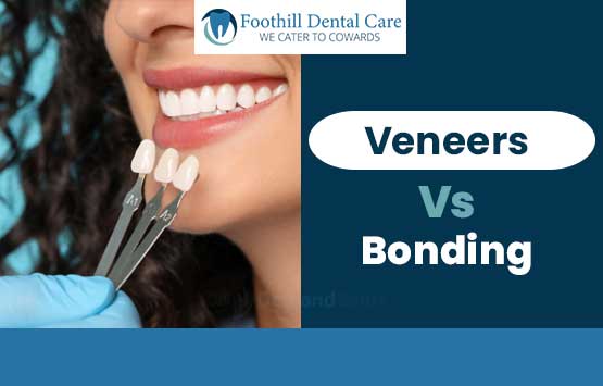 veneers-vs-bonding-Livermore