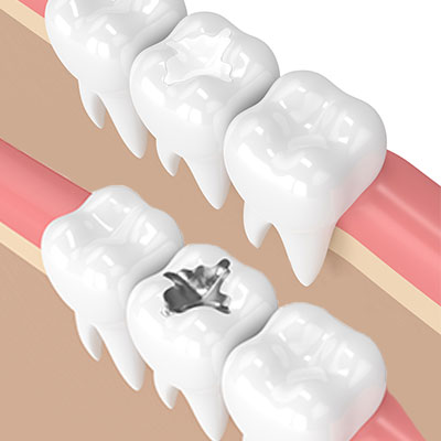Metal Fillings vs Composite Tooth Fillings | Livermore Dentists