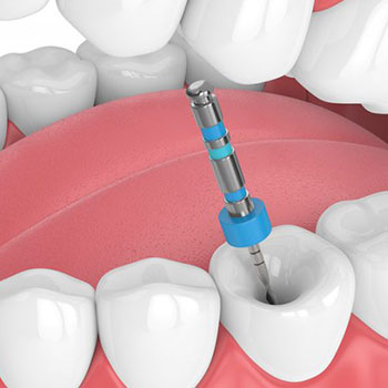 Root Canal Drilling | Livermore Dentist