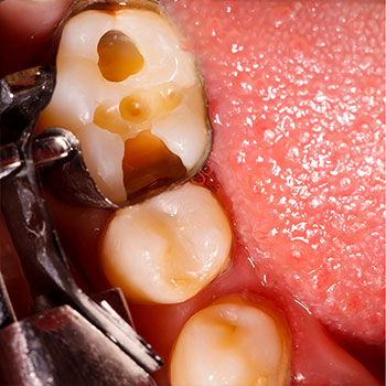 Tooth Cavity Repair with Composite Fillings | Livermore Dentists