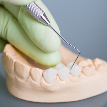 Process for Obtaining a Dental Bridge | Livermore Dentists