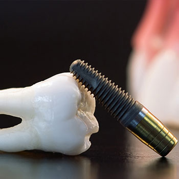Dental Implants with our Livermore Dentists
