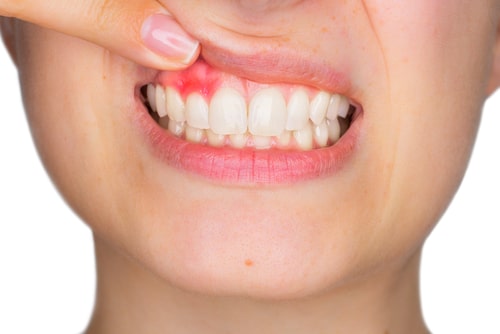 Livermore Dentists can Help Bleeding Gums | Foothill Dental Care