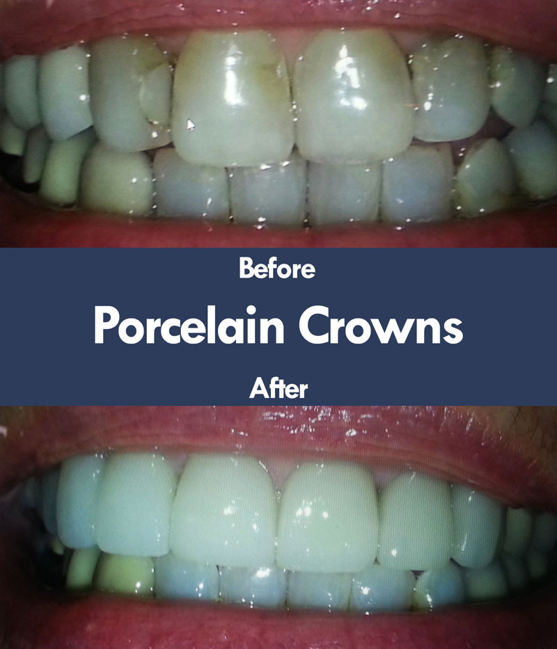 Before & After Porcelain Crowns | Livermore Dentists