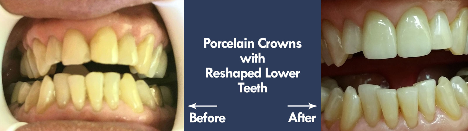 Before & After Porcelain Crowns | Livermore Dentists