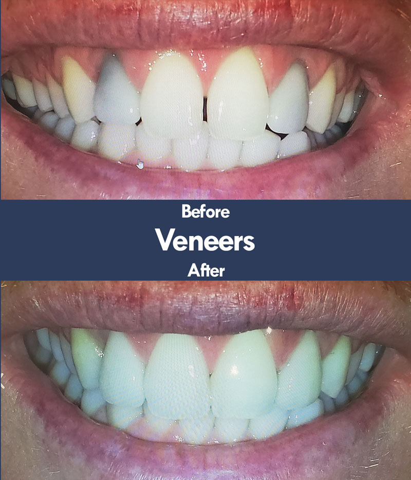 Before & After Dental Veneers | Livermore Dentists