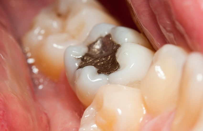 Dental Fillings Need Replacement