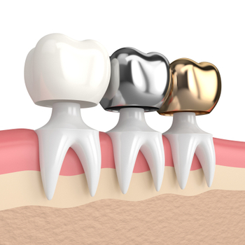 Dental Crowns in Livermore | Livermore Dentists