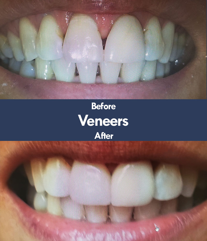 Dental Veneers | Livermore Dentists