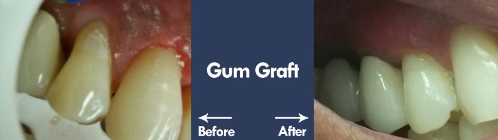 Gum Graft | Livermore Dentists